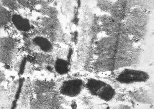 F,56y. | nemaline myopathy v.s.